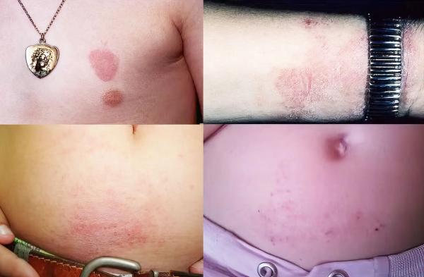 
        Зудящие дерматозы у детей: клиническая симптоматика и тактика лечения			    