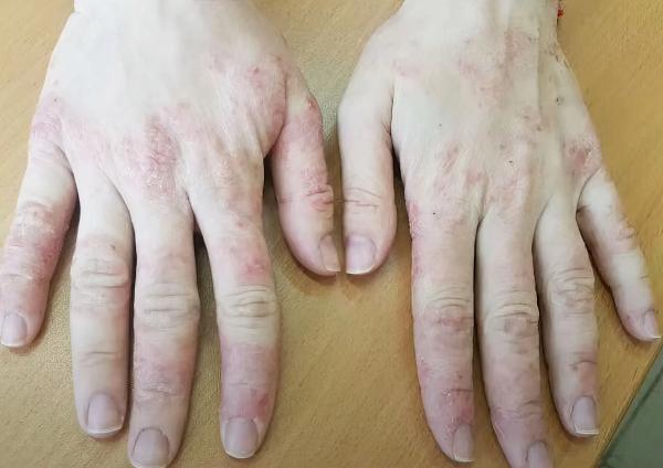 
        Зудящие дерматозы у детей: клиническая симптоматика и тактика лечения			    