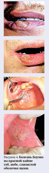
        Клинические проявления предопухолевых заболеваний и рака полости рта			    