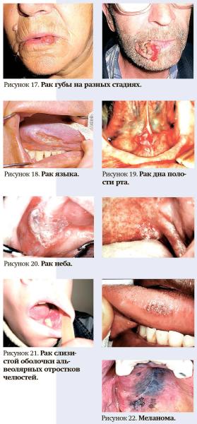 
        Клинические проявления предопухолевых заболеваний и рака полости рта			    