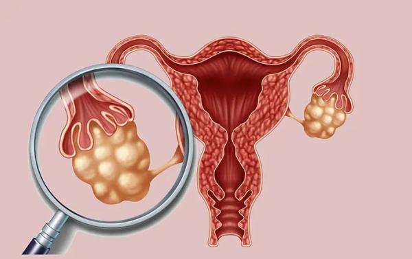 СПКЯ: лечение без гормонов
СПКЯ: лечение без гормонов