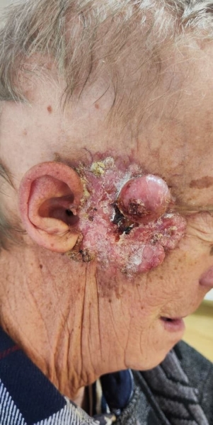 
        Лучевая терапия как вариант лечения нерезектабельных местно-распространенных опухолей кожи                    