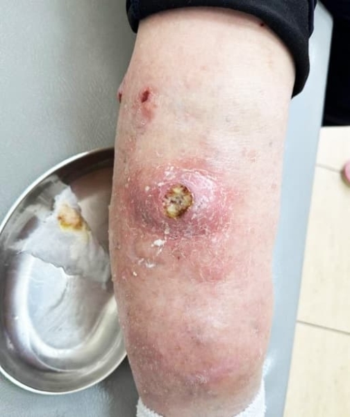 
        Лучевая терапия как вариант лечения нерезектабельных местно-распространенных опухолей кожи                    