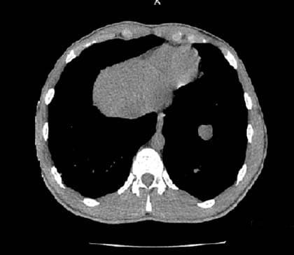 Тестикулярные герминогенные опухоли                     
        Тестикулярные герминогенные опухоли