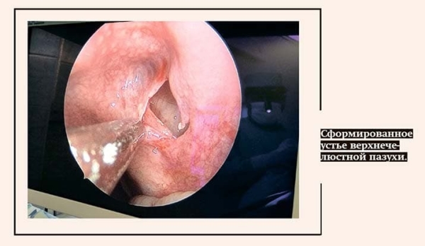 
        Если синус «уснул»… Ателектаз верхнечелюстной пазухи                    