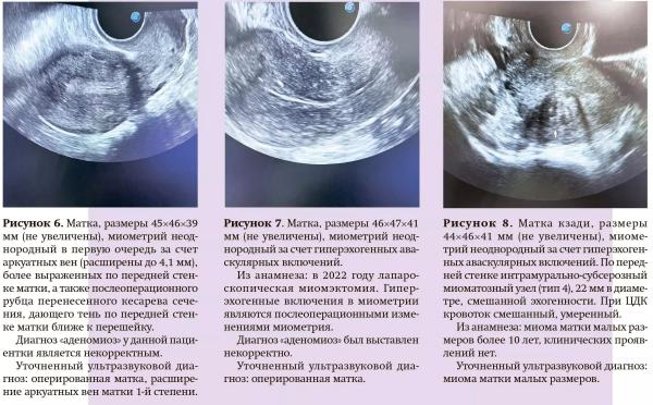 
        Примеры ошибок и гипердиагностика аденомиоза при проведении УЗ-исследований                    