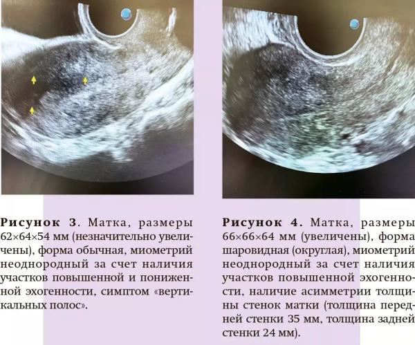 
        Примеры ошибок и гипердиагностика аденомиоза при проведении УЗ-исследований                    