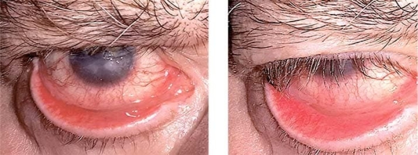 
        Особенности лечения  пациентов с различными видами лагофтальма                    