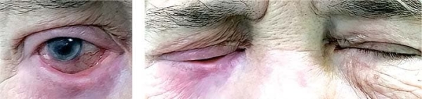 
        Особенности лечения  пациентов с различными видами лагофтальма                    