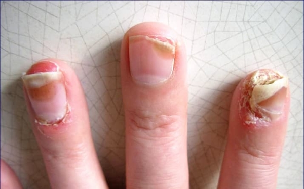 
        Ногти: клинико-диагностическая значимость в практике дерматолога + аудио                
        
        