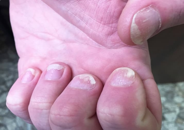 
        Ногти: клинико-диагностическая значимость в практике дерматолога + аудио                
        
        