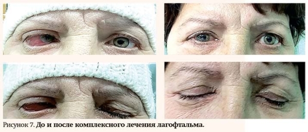 
        Особенности лечения  пациентов с различными видами лагофтальма                    