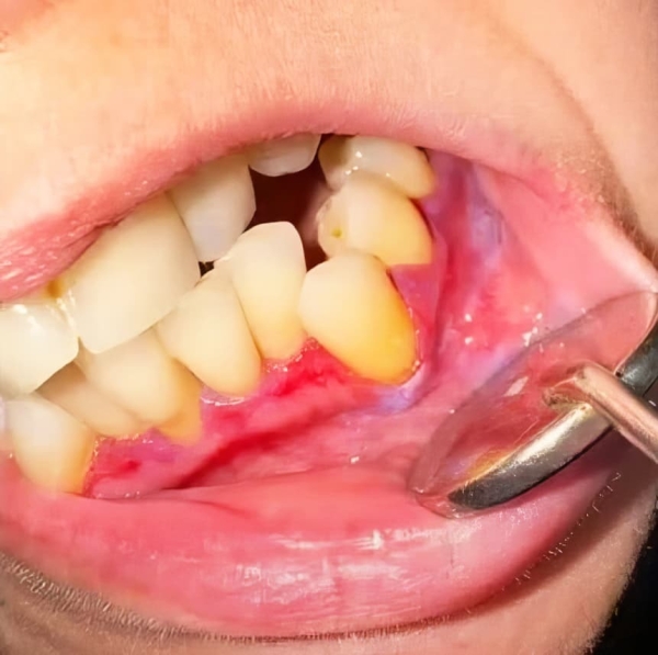 ГЭРБ снимает «маску»: стоматологические проявления, под которыми прячется заболевание + аудио
ГЭРБ снимает «маску»: стоматологические проявления, под которыми прячется заболевание + аудио