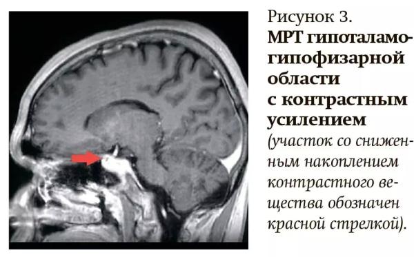 
        Как не пропустить болезнь Кушинга у детей?                    