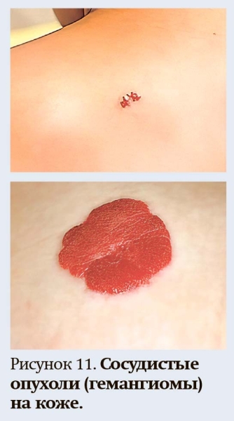 
        Геморрагический синдром: клиническая оценка и тесты                    