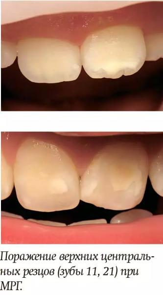 Диагностика и лечение молярно-резцовой гипоминерализации у детей + аудио                
        
         
        Диагностика и лечение молярно-резцовой гипоминерализации у детей + аудио