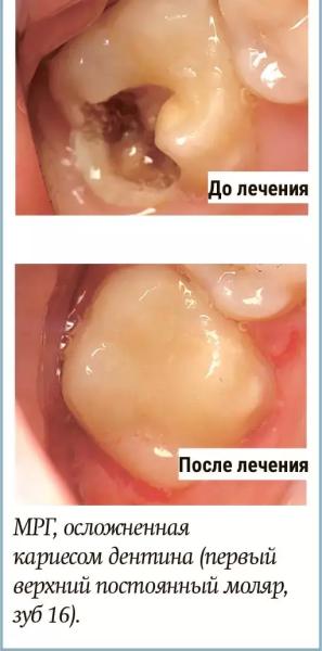Диагностика и лечение молярно-резцовой гипоминерализации у детей + аудио                
        
         
        Диагностика и лечение молярно-резцовой гипоминерализации у детей + аудио