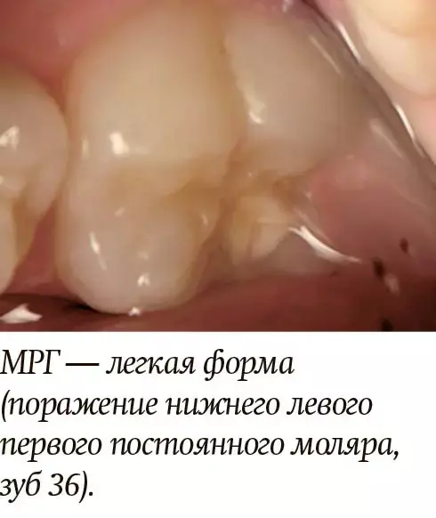 Диагностика и лечение молярно-резцовой гипоминерализации у детей + аудио                
        
         
        Диагностика и лечение молярно-резцовой гипоминерализации у детей + аудио