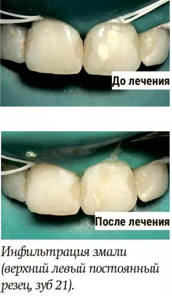 Диагностика и лечение молярно-резцовой гипоминерализации у детей + аудио                
        
         
        Диагностика и лечение молярно-резцовой гипоминерализации у детей + аудио