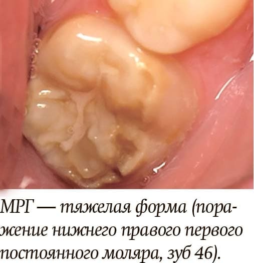 Диагностика и лечение молярно-резцовой гипоминерализации у детей + аудио                
        
         
        Диагностика и лечение молярно-резцовой гипоминерализации у детей + аудио
