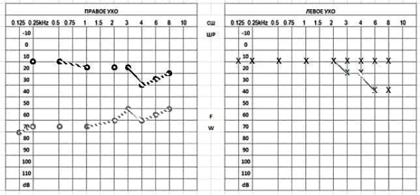 
        Клинический случай семейного отосклероза                    