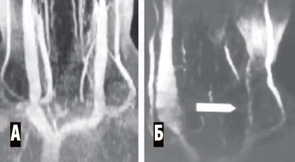 
        Венозная энцефалопатия: постановка диагноза, подходы к лечению                    