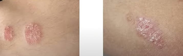 
        Синдром активации тучных клеток. Почему не всегда возможно добиться контроля течения аллергических заболеваний?                    