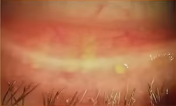 Инфицирование клещом рода Demodex: хронический блефарит, дисфункция мейбомиевых желез и сухой глаз
Инфицирование клещом рода Demodex: хронический блефарит, дисфункция мейбомиевых желез и сухой глаз